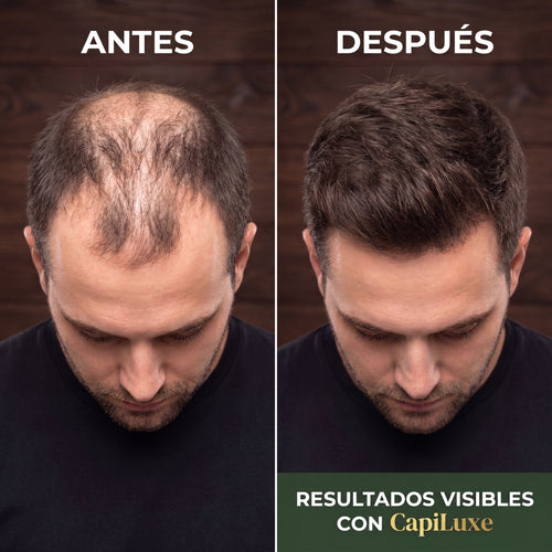 Capiluxe™ | Sérum Anticaída Premium